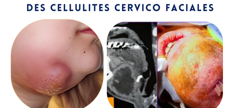 Journée de Formation Médicale Continue : Organisation Multidisciplinaire De La Prise en Charge Des Cellulites Cervico Faciales Mercredi 19 Mars 2025