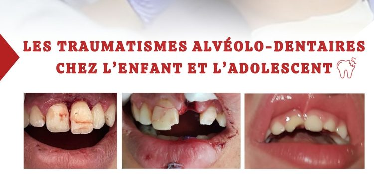 Journée De Formation Médicale Continue : Les Traumatismes Aléolo-Dentaires Chez L’enfant Et L’adolescent Lundi 28 Avril 2025 Journée De Formation Médicale Continue : Les Traumatismes Aléolo-Dentaires Chez L’enfant Et L’adolescent Lundi 28 Avril 2025