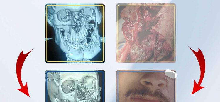 Journée de formation médicale continue : Fractures du massif facial : Particularités de leur prise en charge le Mercredi 21 janvier 2026 Journée de formation médicale continue : Fractures du massif facial : Particularités de leur prise en charge le Mercredi 21 janvier 2026