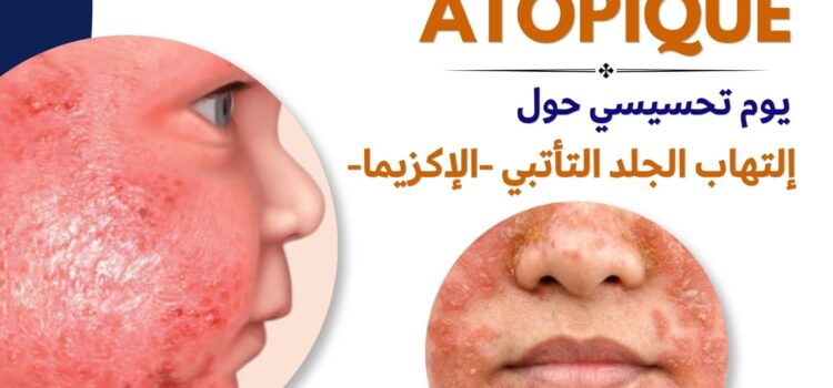 Journée de Sensibilisation sur la Dermatite Atopique (L&rsquo;eczéma )  Lundi 14/09/2026